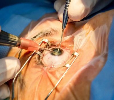 Cataract Surgeries (1)